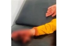 2 Pemuda di OKI Jari Tangannya Hancur Usai Terkena Ledakan Petasan